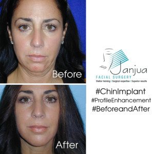 Rhinoplasty and Chin Implant