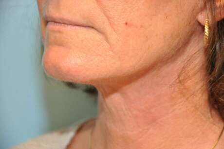 Facelift Surgery Photos