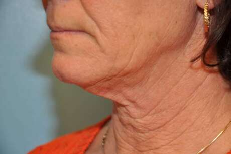 Facelift Surgery Photos