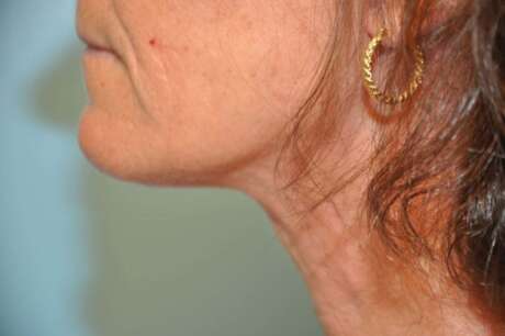 Facelift Surgery Photos