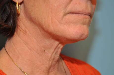 Facelift Surgery Photos