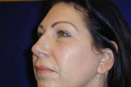 Facelift Surgery Photos