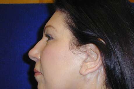 Facelift Surgery Photos