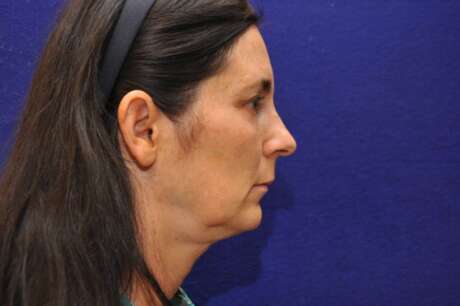 Facelift Surgery Photos