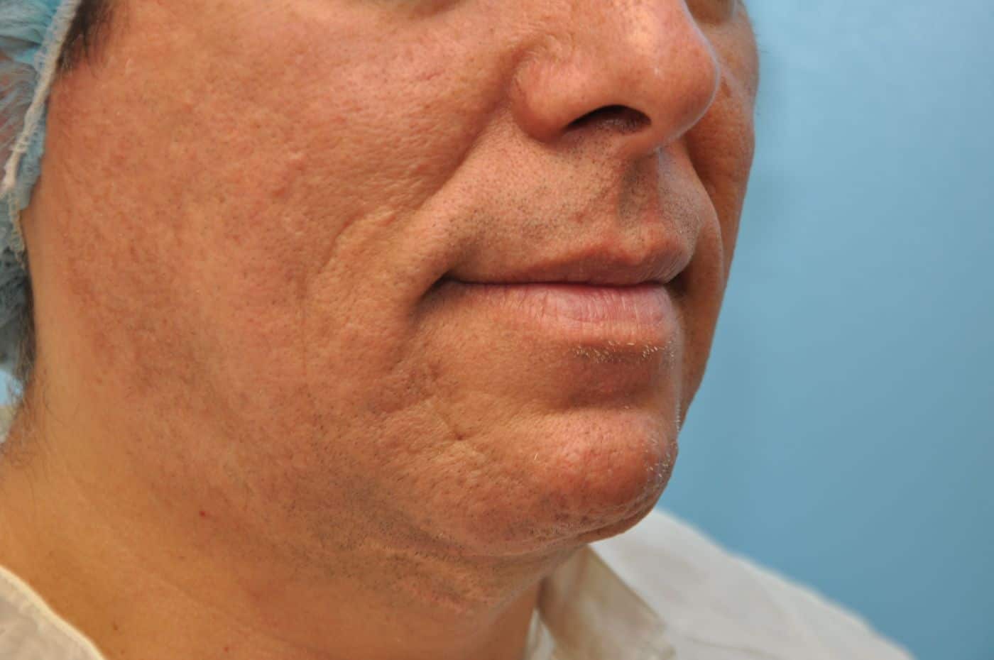 jowllipo102b Janjua Facial Surgery