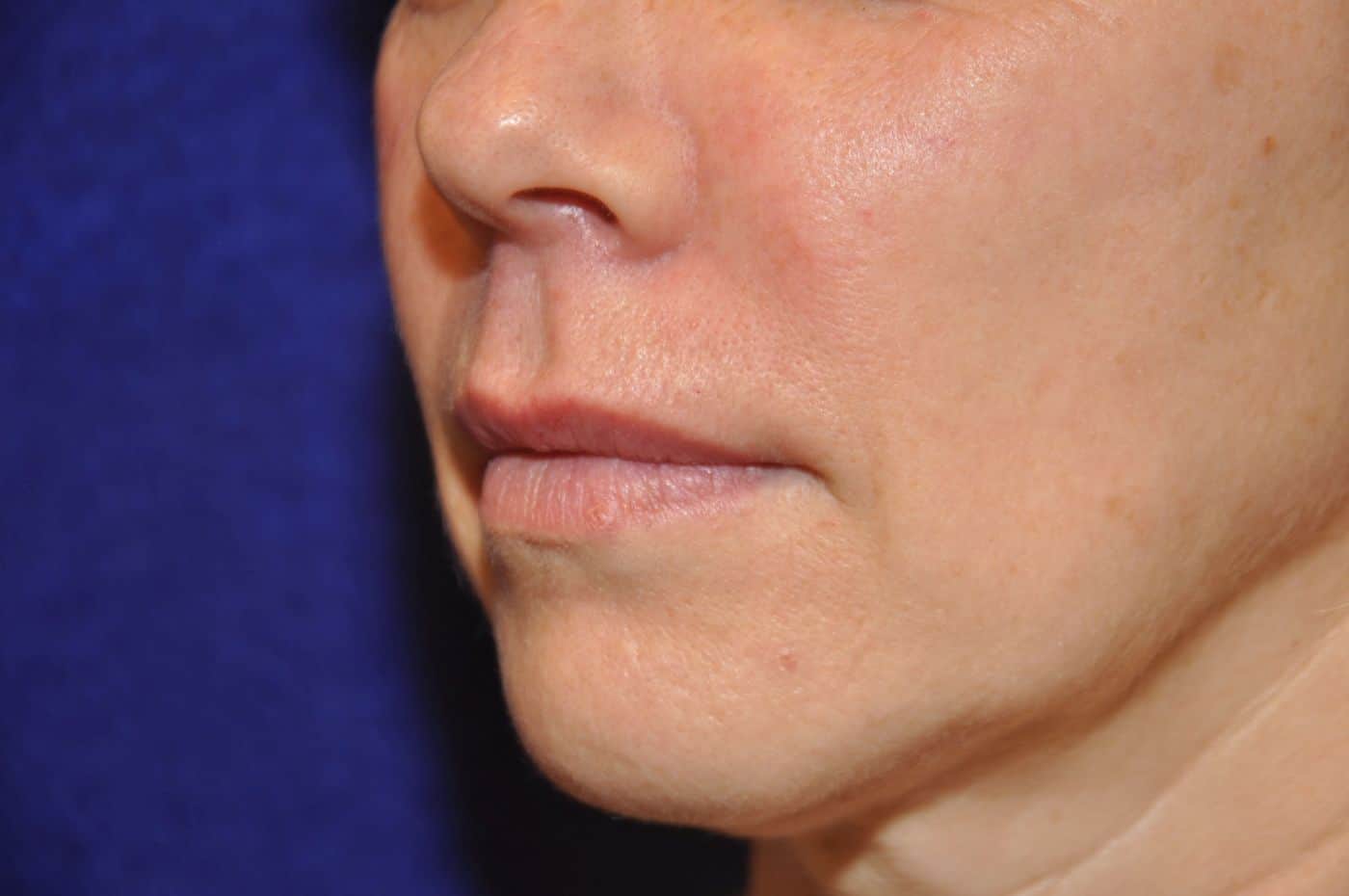 Botox & Fillers Photos