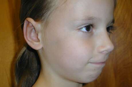Ears Surgery Photos