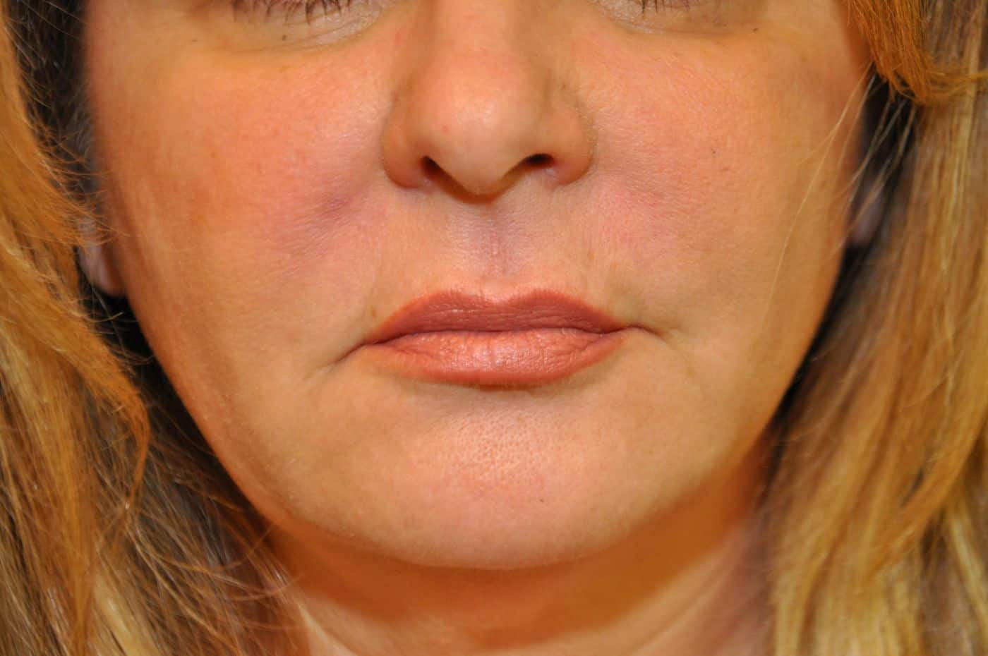 Botox & Fillers Photos