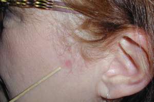 skincancer-cheek-501b