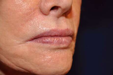 Lip Reduction Photos