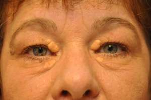 xanthelasma-101b