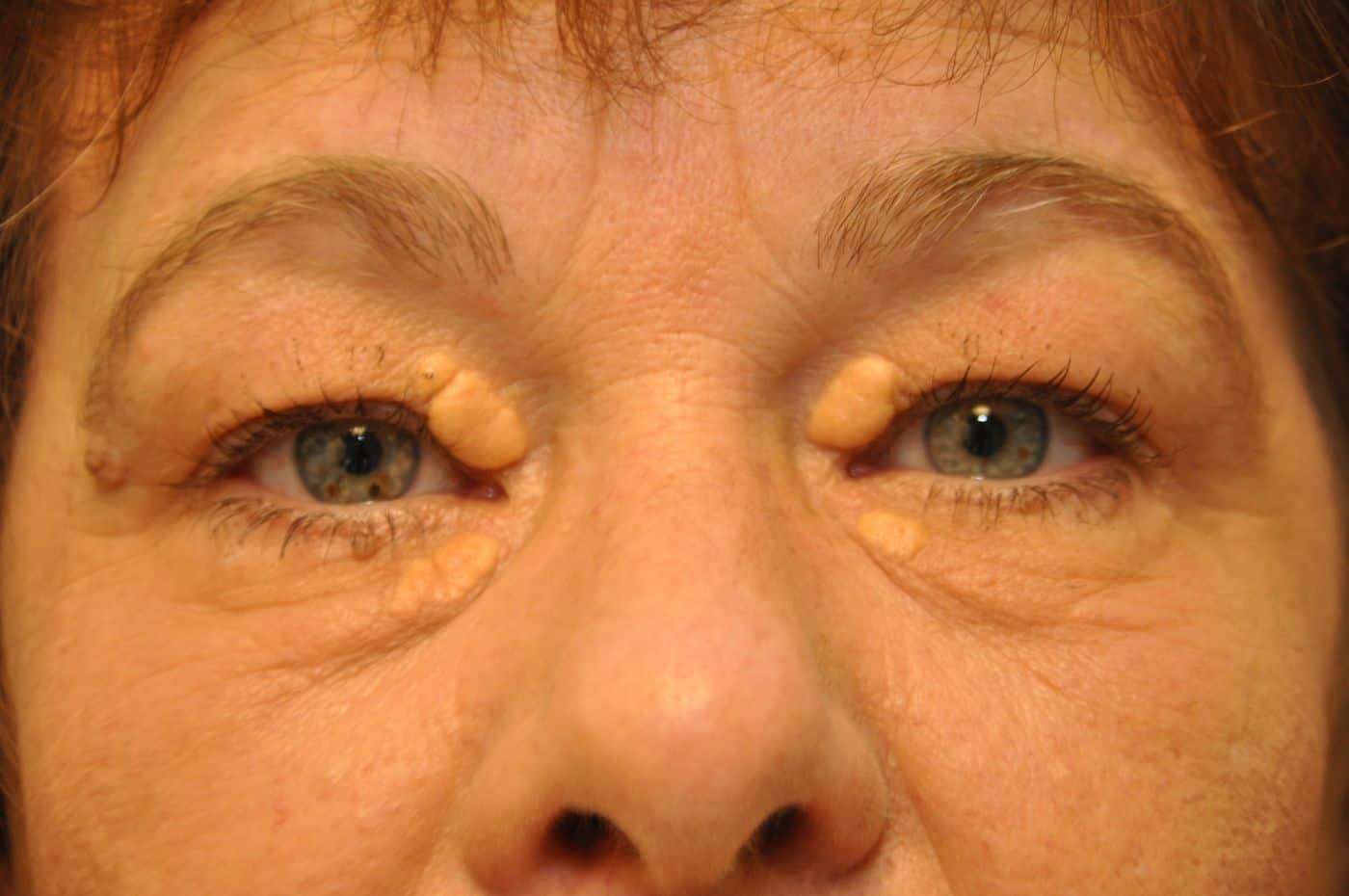 xanthelasma-101b - Janjua Facial Surgery