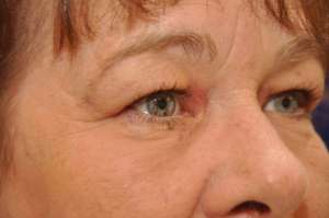 xanthelasma-102a