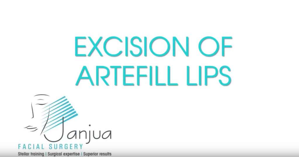 excisionartefilllips Janjua Facial Surgery