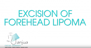 excision-of-lipoma