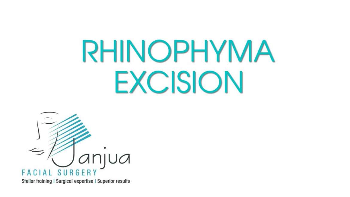 rhinophyma-excision | Janjua Facial Surgery