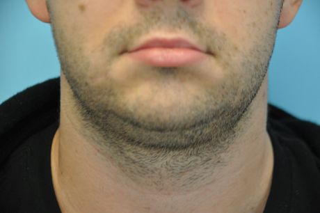 Chin Implant Photos