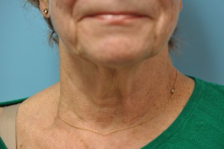 Facelift Surgery Photos