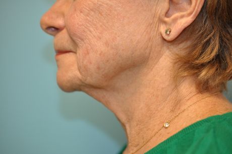 Facelift Surgery Photos