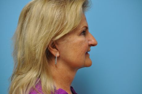 Facelift Surgery Photos