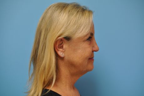 Facelift Surgery Photos