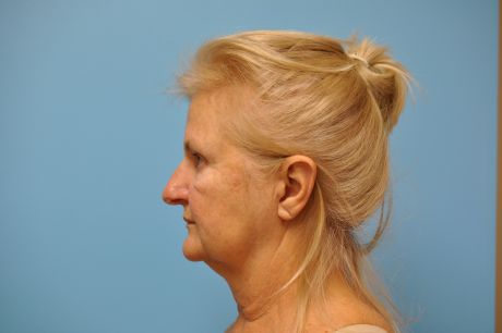 Facelift Surgery Photos