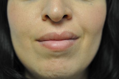 Lip Reduction Photos