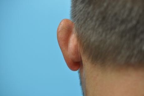Ears Surgery Photos