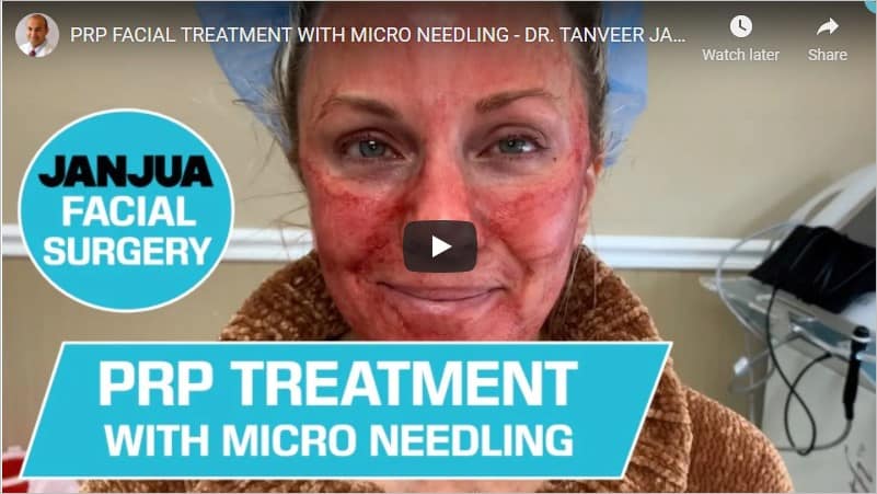 PRP Treatment with Microneedling