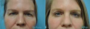 eye-surgery-before-after-featured-1