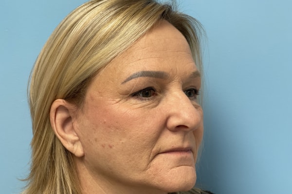 Facelift Surgery Photos