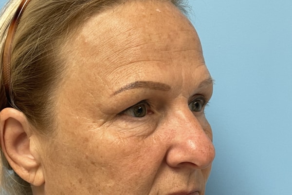 Facelift Surgery Photos