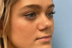 alarplasty-before-2-3