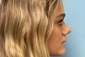 alarplasty-before-2-5