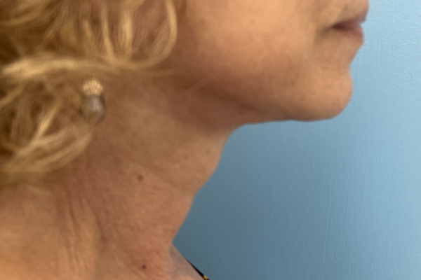 Facelift Surgery Photos