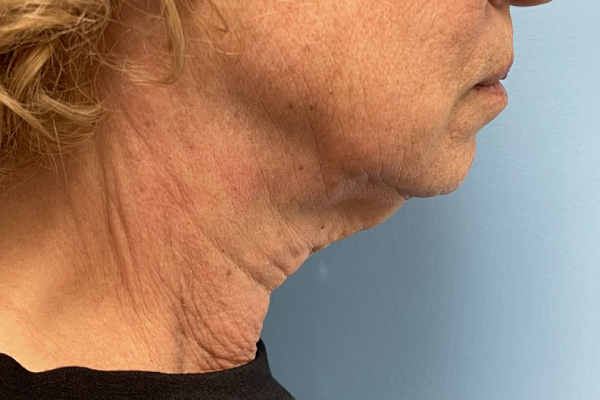 Facelift Surgery Photos