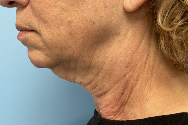 Facelift Surgery Photos