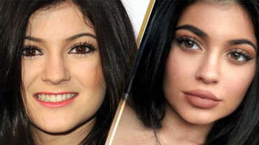 Kylie Jenner Gets Her Lips Done