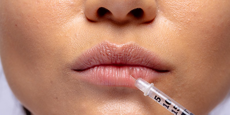 Lip Augmentation  South Florida Facial Plastic Surgery