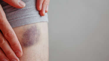 How To Avoid Surgical Bruising