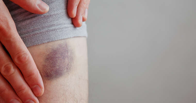 How To Avoid Surgical Bruising