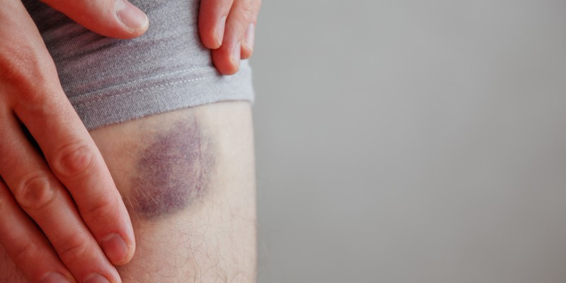 How To Avoid Surgical Bruising