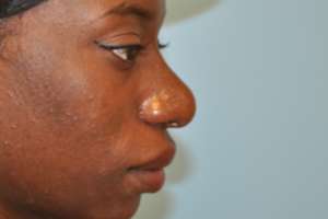 african-american-rhinoplasty-101-a
