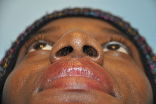 Nose Photos