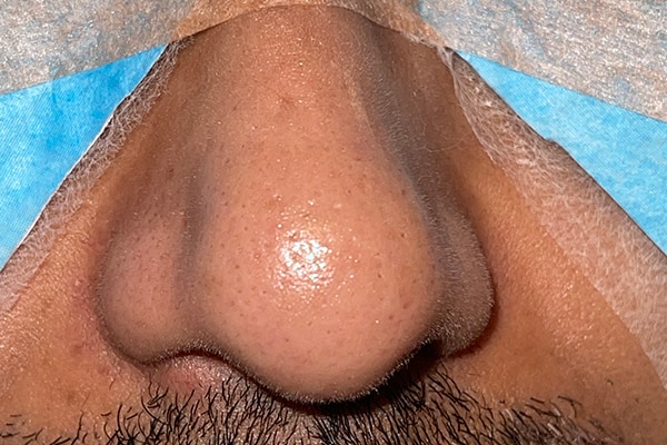 Nose Photos