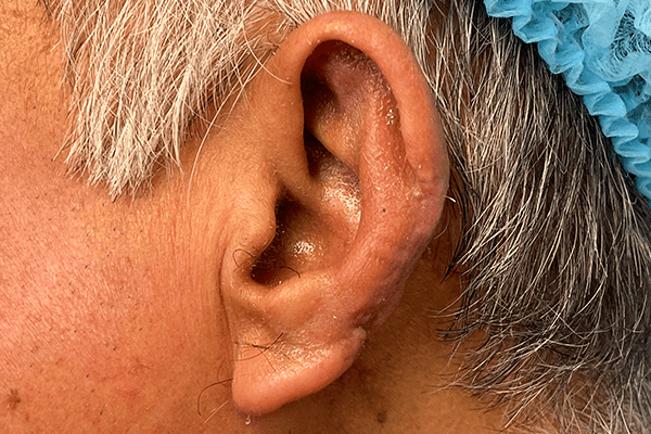 Ears Surgery Photos