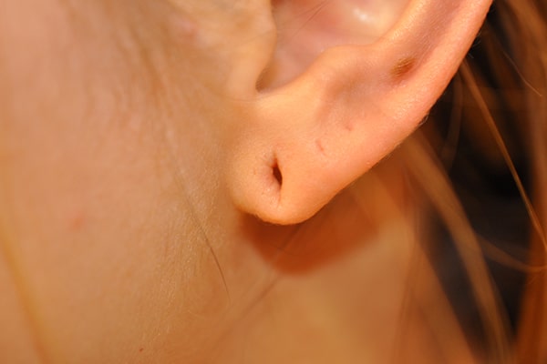 Ears Surgery Photos