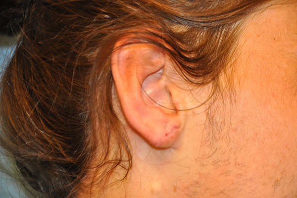 Ears Surgery Photos