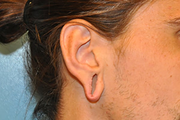 Ears Surgery Photos