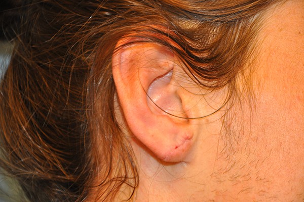 Ears Surgery Photos